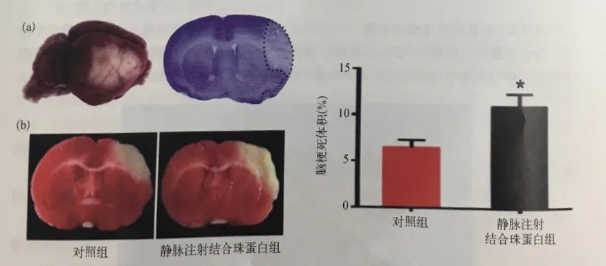 大脑中动脉远端阻塞后梗死部位检测