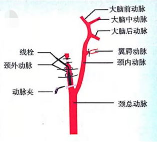 分离颈总动脉