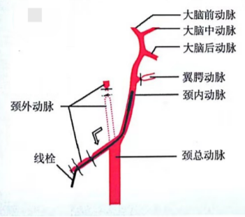 双线结扎颈外动脉