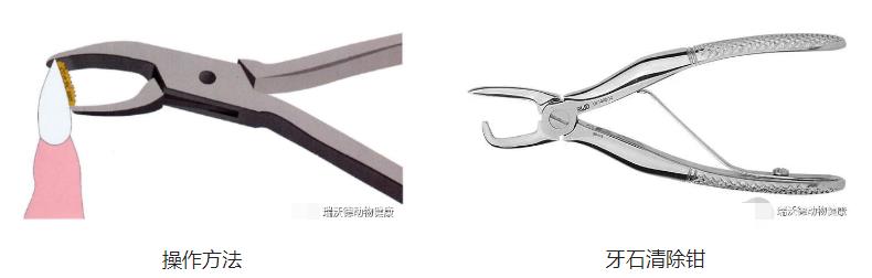 大块牙结石去除