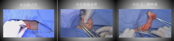 子宫结扎